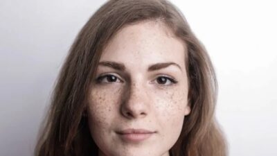 Mengatasi Dermatitis Perioral: Rutinitas Skincare yang Efektif