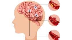 Dampak Sistem Rujukan terhadap Pasien Stroke di Indonesia