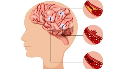 Dampak Sistem Rujukan terhadap Pasien Stroke di Indonesia