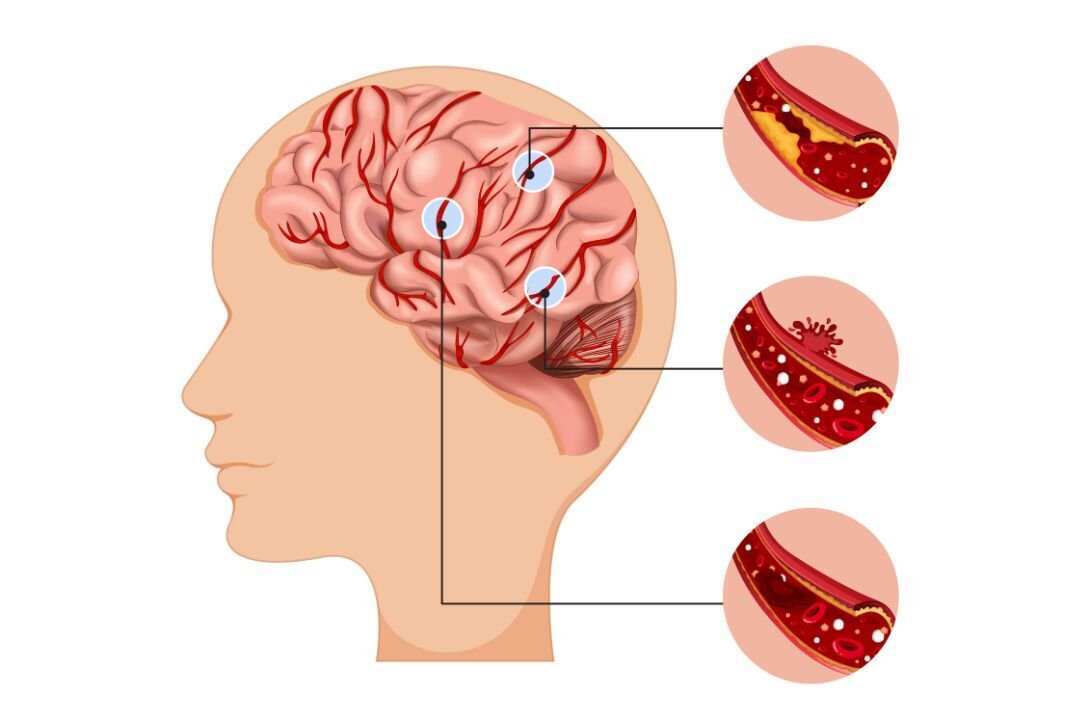 Dampak Sistem Rujukan terhadap Pasien Stroke di Indonesia